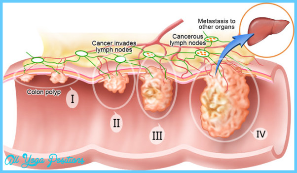 Colon And Rectal Cancer